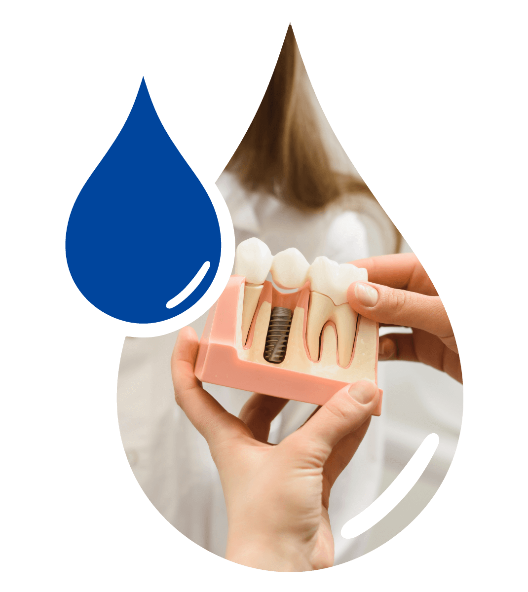 The Security of Dental Implants